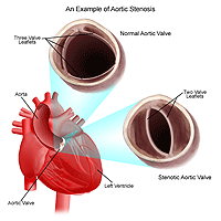 Click Image to Enlarge Illustration of aortic stenosis