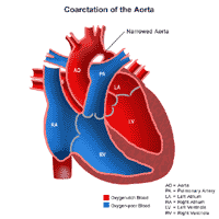 Click Image to Enlarge Anatomy of a heart with a coarctation of the aorta