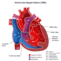 Click Image to Enlarge Anatomy of a heart with ventricular septal defect